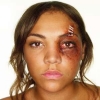 domestic violence woman black eye 2 small square white bg 300x300