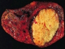 diseased lung cancer 2 rec bla bg 1024x768