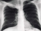 lung xray 1024x768