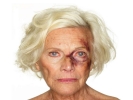 domestic violence elderly woman black eye large landscape white bg 1024x768