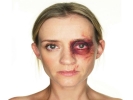 domestic violence woman black eye large landscape white bg 1024x768