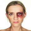 domestic violence woman black eye small square white bg 300x300