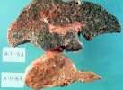 liver diseased larger