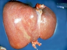 liver enlarged 800x600